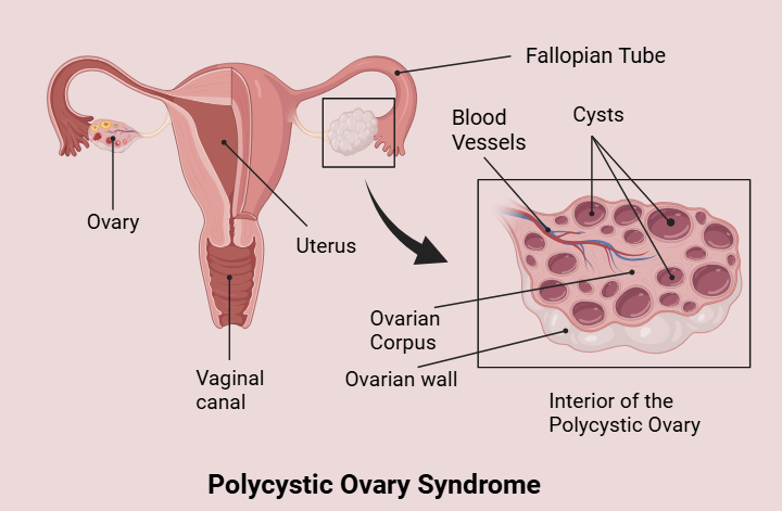 PCOS-diagram-AFIC